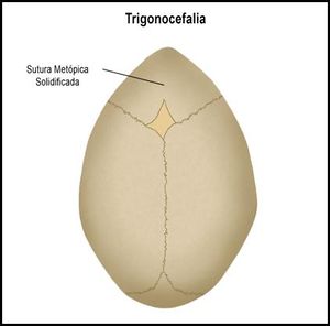 Trigonocefalia.jpg